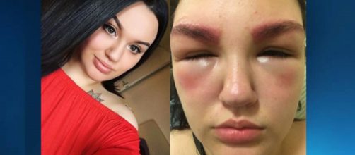 Hannah n&atilde;o passou por teste al&eacute;rgico antes da pigmenta&ccedil;&atilde;o das sobrancelhas (Foto/Reprodu&ccedil;&atilde;o)