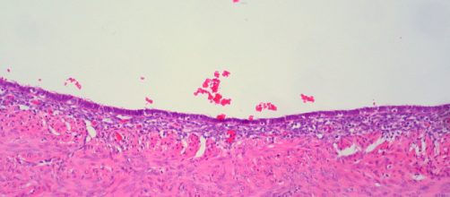 Endometriosis of the fallopian tube. - [Ed Uthman / Flickr]