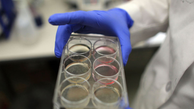 Sclerosi multipla, in Italia la prima infusione di cellule staminali
