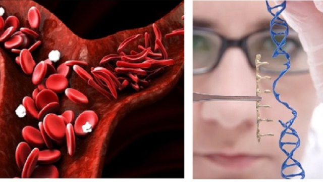 E&rsquo; in fase di approvazione la prima terapia genica in grado di risolvere il problema dei talassemici evitandogli continue trasfusioni.