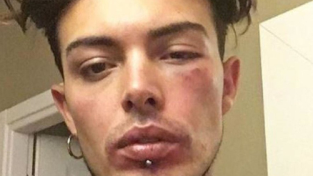 Stash col volto tumefatto: l'artista coinvolto in una zuffa per aver difeso una ragazza