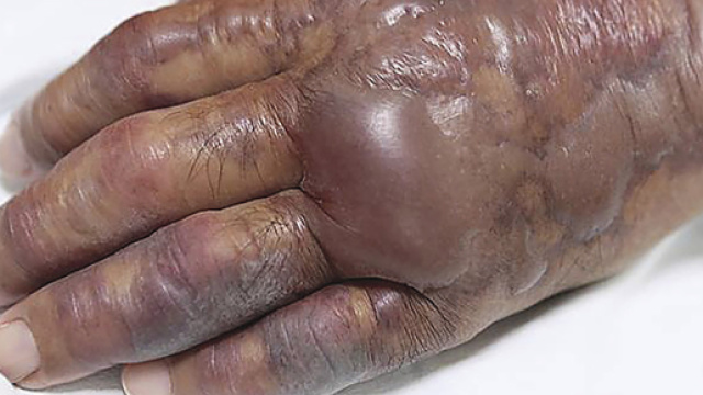 mano amputata dopo aver mangiato sushi