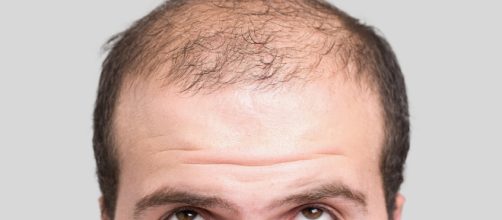 Estudio podr&iacute;a arrojar luz para combatir la calvicie