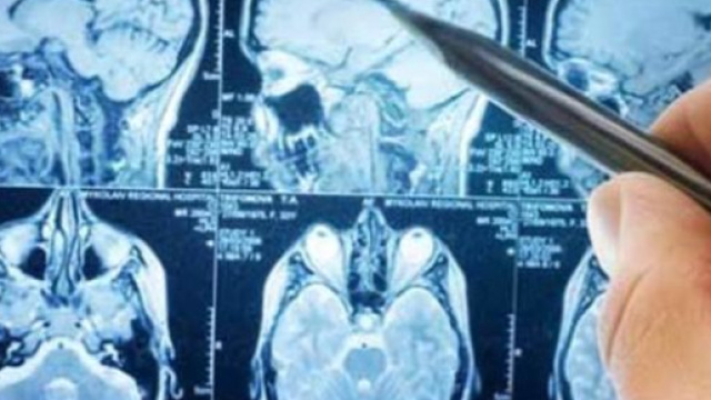 Sclerosi multipla: scoperto un nuovo biomarcatore