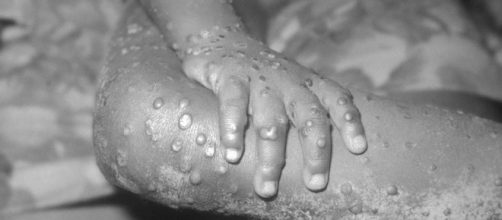 . A young boy infected with monkeypox Image credit Centers for Disease Control and Prevention
