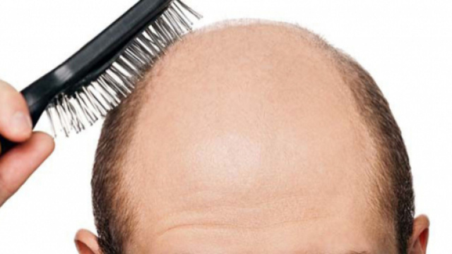 Calvizie: il nuovo studio indica nel profumo di sandalo il possibile rimedio