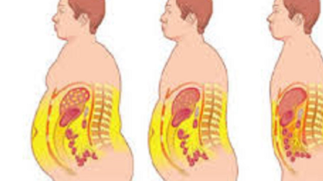 Il grasso corporeo in eccesso pu&ograve; aumentare il rischio di cancro del colon