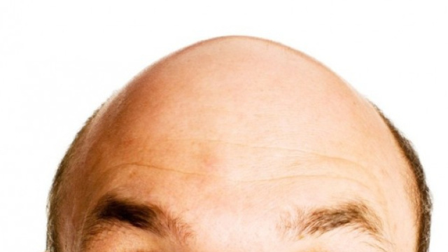 Calvizie: in Europa ogni anno il 15% in pi&ugrave; di trapianto capelli ... - gosalute.it
