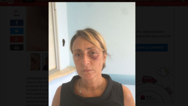 Lecce, infermiera 118 presa a calci e pugni: la donna mostra le foto dell'aggressione subita in ambulanza.