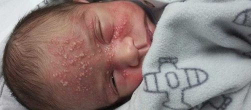 Beb&ecirc; pegou herpes ainda na maternidade (Reprodu&ccedil;&atilde;o: Facebook)