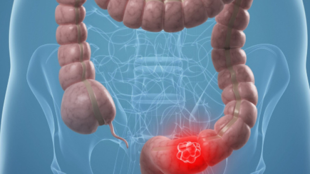 Alcuni sani consigli per una buona prevenzione del cancro al colon-retto.