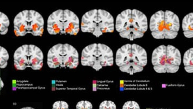 Scansioni di risonanza magnetica di cervello di adolescente consumatore e non: si evidenziano le alterazioni di volume in specifiche aree
