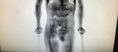 Homem &eacute; detido com objetos no est&ocirc;mago. Fonte: G1.