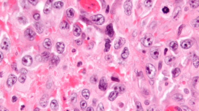 Alcuni fattori di rischio del sarcoma.