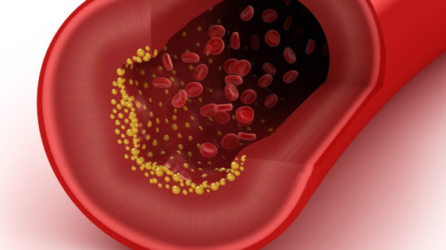 Colesterolo alto: cinque cibi da evitare