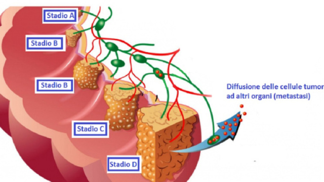 L&rsquo;individuazione di biomarcatori specifici consentir&agrave; la diagnosi precoce del cancro al colon-retto in modo non invasivo.