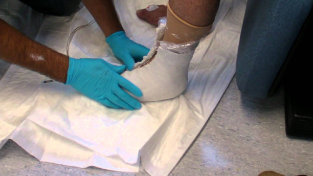 Piede diabetico: alcuni consigli per la cura.