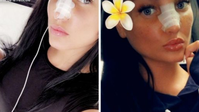 Aur&eacute;lie Dotremont : apr&egrave;s sa rhinoplastie, elle d&eacute;voile le r&eacute;sultat ! - gossip-room.fr