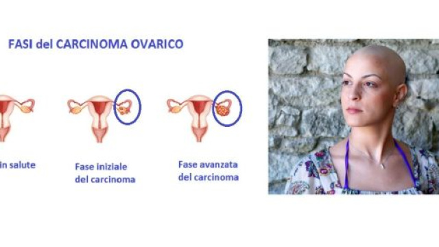 Gli inibitori PARP bloccano i meccanismi di riparo. Se associati alla chemio, migliorano la sopravvivenza nei casi di carcinoma ovarico avanzato.