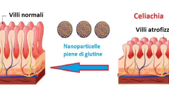 Una nuova tecnologia basata sull&rsquo;uso di nanoparticelle potrebbe bloccare la reazione al glutine nei celiaci.