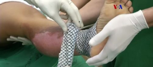 Piel de tilapia, terapia para quemaduras - voanoticias.com