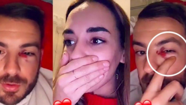 Julien Bert gravement bless&eacute; &agrave; l&rsquo;&oelig;il &agrave; cause de sa ch&eacute;rie Hilona, il raconte tout. @Snapchat : Julien Bert / Hilona.