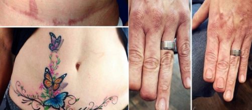Tatuagem criativa para esconder marcas e cicatrizes. (Foto/Reprodu&ccedil;&atilde;o via Tudo Interessante).
