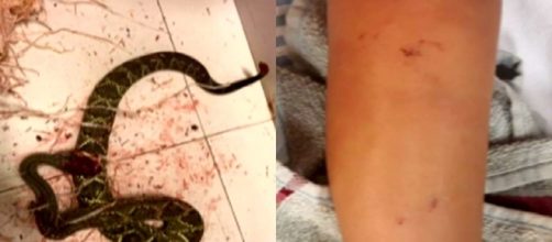Menino &eacute; picado por cobra duas vezes - (Foto: Reprodu&ccedil;&atilde;o/TV Anhanguera)