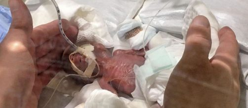 Beb&ecirc; que nasceu pesando 238 gramas em T&oacute;quio recebe alta (Reprodu&ccedil;&atilde;o: Keio University School of Medicine/Reuters)