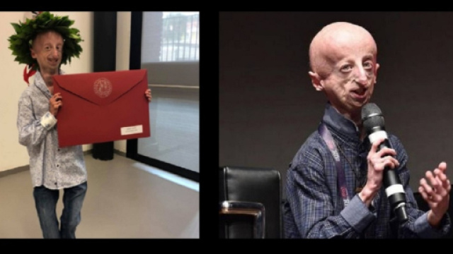 Sammy Basso, un ragazzo affetto da progeria, lo scorso anno si &egrave; laureato e ora &egrave; stato sottoposto ad un delicato intervento chirurgico al cuore.
