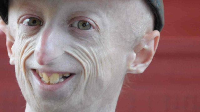 Sammy Basso, il 23enne malato di progeria operato con successo al ... - ultimavoce.it