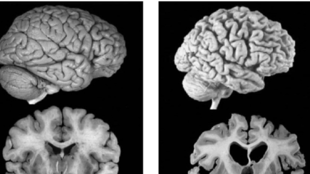 Sono stati identificati due nuovi biomarker dell&rsquo;Alzheimer, che potrebbero consentire una diagnosi molto precoce della malattia.