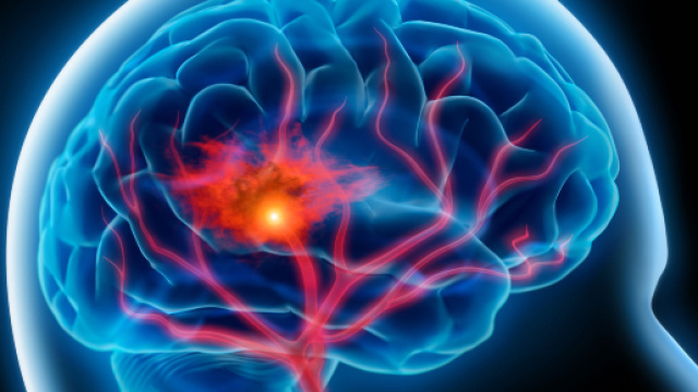 Ictus giovanile, la malattia cerebrovascolare che interessa i giovani