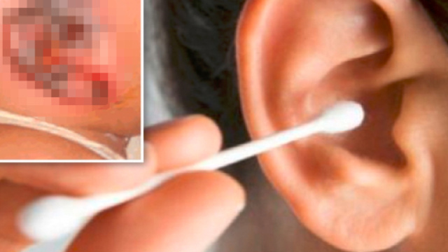 Cotton fioc resta incastrato e arriva al cervello: 31enne prende infezione e rischia di morire - Teleclubitalia