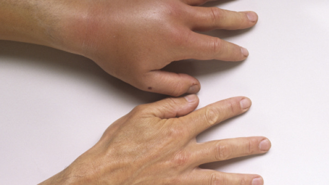 Piq&ucirc;res d'abeilles, de gu&ecirc;pes, de frelons et de fourmis - L&eacute;sions ... - msdmanuals.com