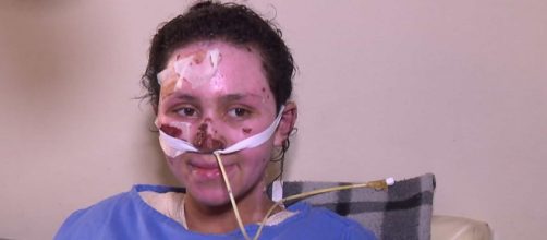 Morre a menina que teve 60% do corpo queimado ao salvar irm&atilde;o (Foto: Reprodu&ccedil;&atilde;o/RPC)