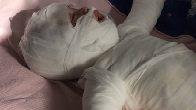 Bimba di 11 mesi cade nella pentola dell'acqua bollente mentre fa il bagnetto, gravissima in ospedale - Il Mattino