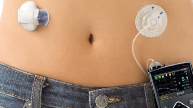 Milioni di pazienti, con diabete tipo 1, potranno beneficiare di ipertecnologici device, basati su algoritmi, per il controllo H24 della glicemia