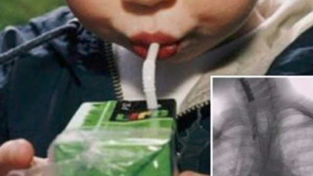 Bari. Acido nel succo di frutta, bimbo di 5 anni con stomaco e esofago bruciati - Teleclubitalia