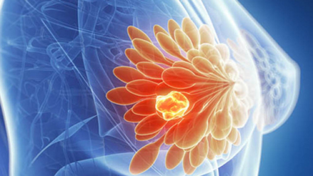 Cancro alla mammella: uno studio recente individua un nuovo approccio grazie ad alcuni geni.