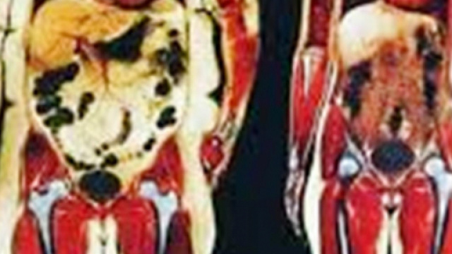 Alcuni probiotici contrastano grasso epatico e viscerale.