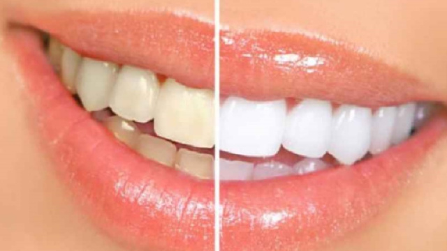 Sempre pi&ugrave; diffusi i prodotti per lo sbiancamento dei denti ma questi possono essere anche pericolosi se usati in modo improprio