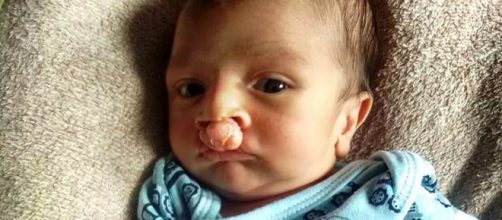 Beb&ecirc; com malforma&ccedil;&atilde;o no c&eacute;u da boca. (Reprodu&ccedil;&atilde;o/Arquivo pessoal)