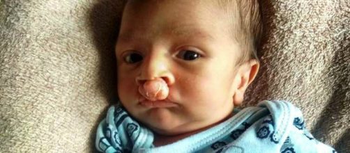 Beb&ecirc; nasceu com l&aacute;bio leporino. (Reprodu&ccedil;&atilde;o/Arquivo Pessoal)