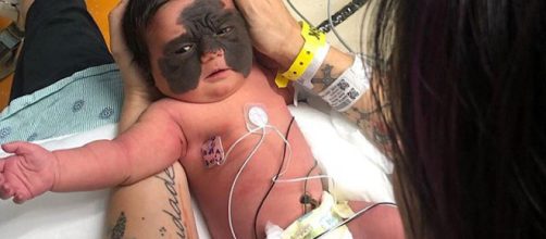 Chamada de Nevo Melanoc&iacute;tico Cong&ecirc;nito, condi&ccedil;&atilde;o atinge aproximadamente 1% dos rec&eacute;m-nascidos. (Reprodu&ccedil;&atilde;o/ Instagram/ @luna.love.hope)