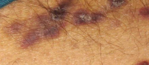 Alguns sintomas de um portador de HIV. (Divulga&ccedil;&atilde;o/ Flickr)