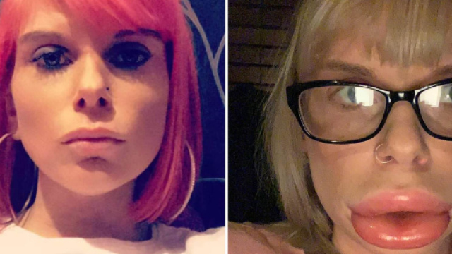 Mother Left With Out of Control 'Sausage Lips' After Using At-home ... - australianewsly.com