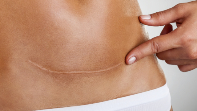 Un accouchement par c&eacute;sarienne, pourquoi et comment ? M comme Maman - mcommemaman.fr