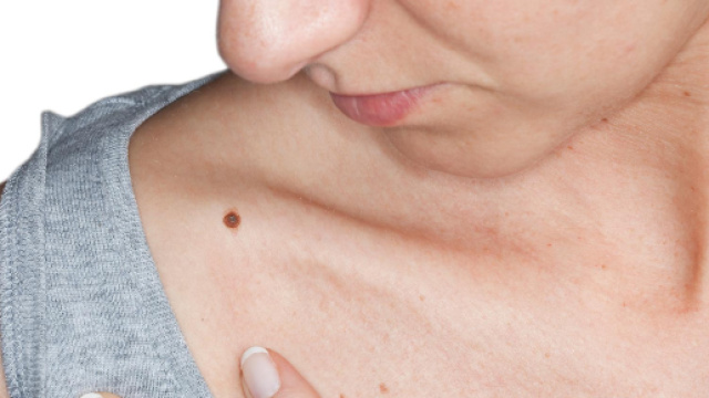 Distinguere un neo da un melanoma: la regola dell'Abcde.
