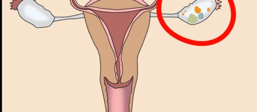 3 formas de saber si tienes un quiste ov&aacute;rico - wikiHow - wikihow.com